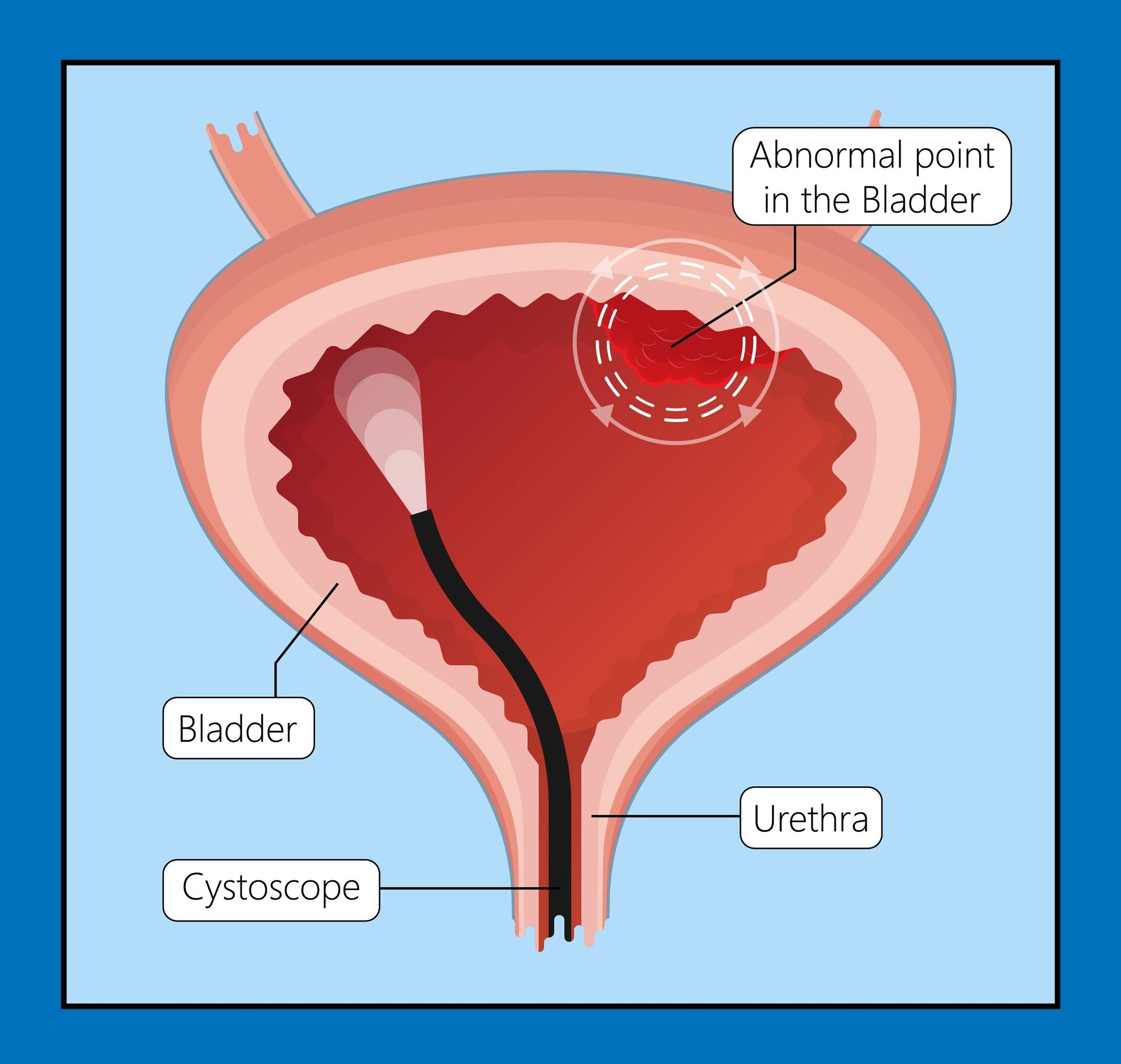 Cystoscopy. Diagram of how a small camera can be inserted into the bladder.