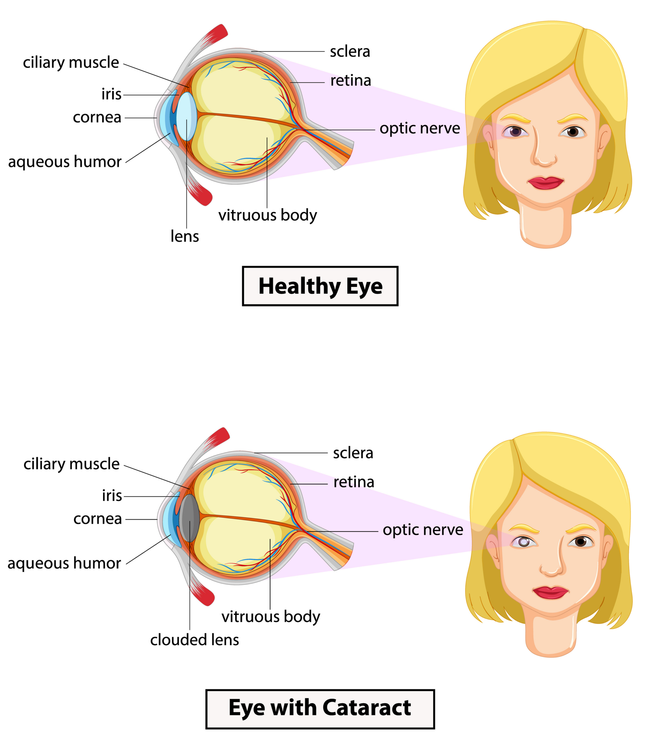 Scientific medical illustration of cataract of human eye