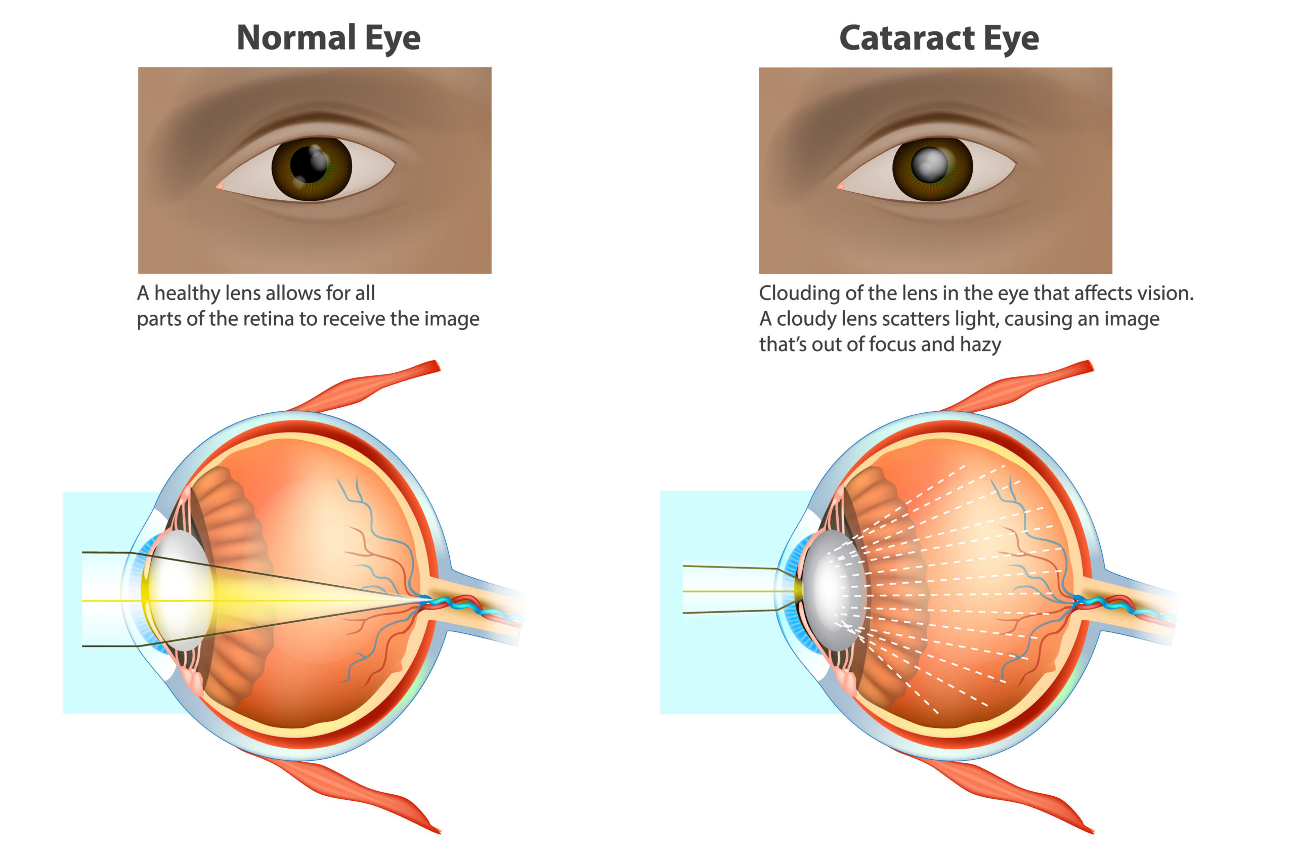 Graphic showing a healthy eye, and an eye with a cataract